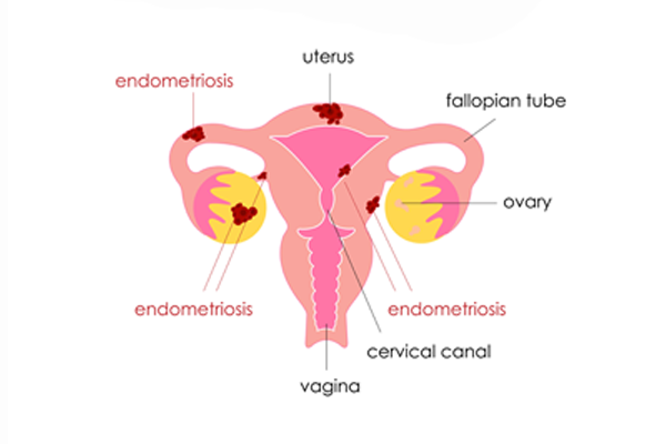 Endometriosis