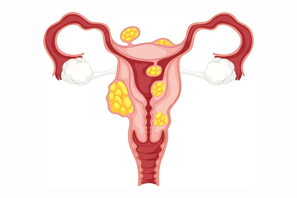 Fibroids